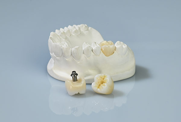 After dental implant, how should patients choose dental crown? Let's hear what the doctor says
